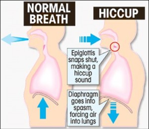 hiccups