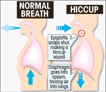 To hiccups how cure How to